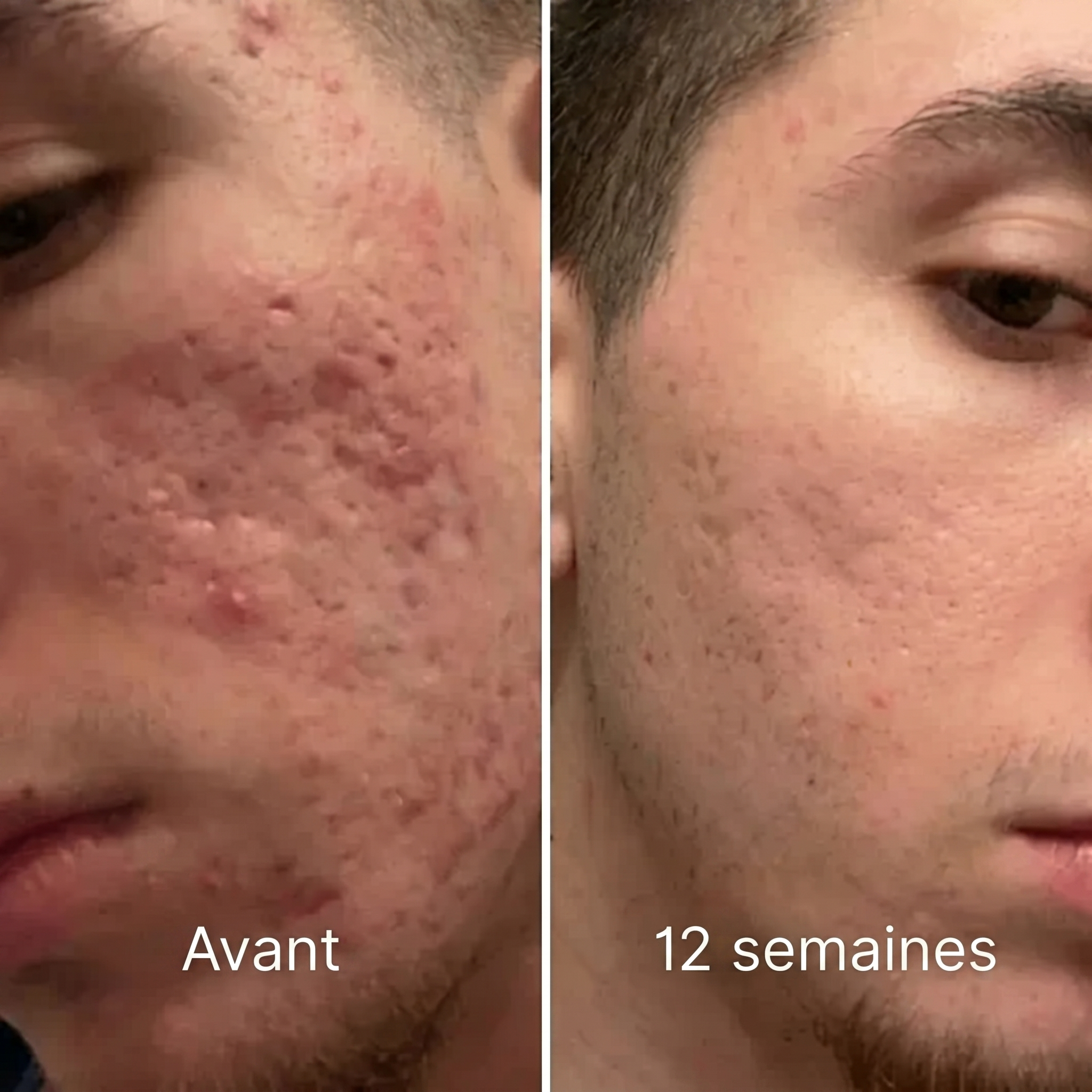 Stick clinique pour cicatrices d'acné - Vivrel™