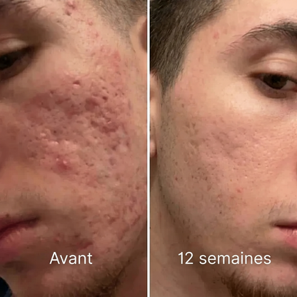Stick clinique pour cicatrices d'acné - Vivrel™
